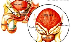 Phì đại tuyến tiền liệt có phải là ung thư không?