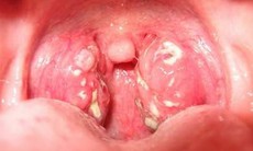Viêm Amidan