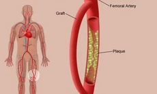 Đau cứng bắp chân, bệnh gì?