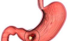 Ðể biết rõ viêm dạ dày do H.pylori