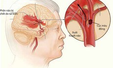 Phát hiện sớm đột quỵ não, hạn chế di chứng