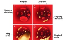 Mỡ máu cao, điều trị không hiệu quả vì sao?