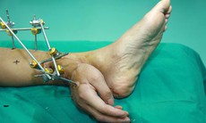 Những chuyện khó tin về ghép bộ phận cơ thể