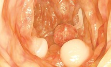 Bệnh polyp trực tràng có nguy hiểm không?