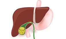 Bệnh sỏi mật - cần phát hiện và điều trị sớm