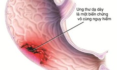 Biến chứng do bệnh viêm, loét dạ dày - tá tràng