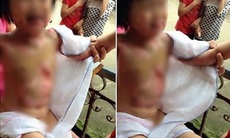 Bé gái mầm non bị bạn học đốt gây bỏng nặng trong lớp học