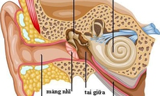 Ù tai có thể gây điếc