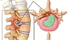 Cấy chỉ điều trị thoái hóa và thoát vị đĩa đệm cột sống thắt lưng