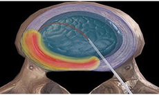 Ứng dụng sóng cao tần thế hệ mới trong phẫu thuật cột sống ít xâm lấn