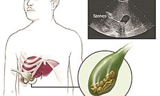 Điều trị sỏi mật theo Đông y