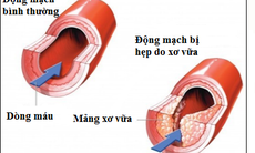 Sẽ có động mạch nhân tạo