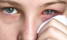 Đau mắt đỏ khi nào cần đi khám?