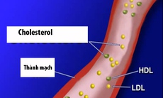 Statin cứu cánh  bệnh nhân tim mạch