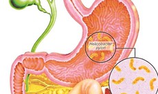 Dùng thuốc trị viêm loét dạ dày  - tá tràng
