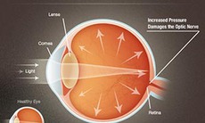 Nhận biết Glaucoma sớm để tránh mù lòa