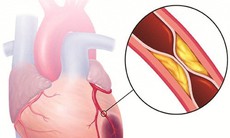 Cách phát hiện sớm nhồi máu cơ tim