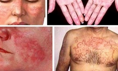 Chữa lupus ban đỏ, cần lưu ý độc tính của thuốc