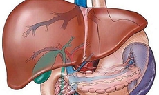 Xơ gan cổ chướng
