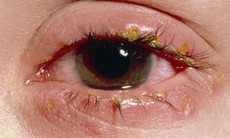 5 cách để phòng bệnh đau mắt đỏ mùa nắng nóng