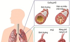 Người nghiện thuốc lá: Khó tránh khỏi bệnh phổi tắc nghẽn mãn tính