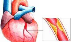 Gắng sức về trí óc và thể lực, kẻ đồng hành gây bệnh tim