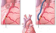 Ai cần phẫu thuật bắc cầu nối động mạch vành?