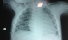 Bé 3 tuổi bị thủng phổi vì kim đâm xuyên ngực