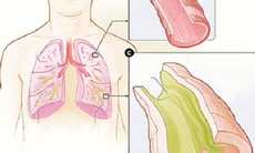 Giãn phế quản sau lao phổi chữa thế nào?