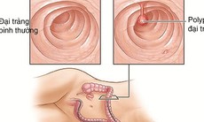 Có nên cắt bỏ polyp đại tràng không?