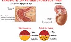 Bệnh tăng huyết áp có thể dẫn đến suy thận