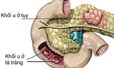 Thuốc điều trị hội chứng Zollinger - Ellison