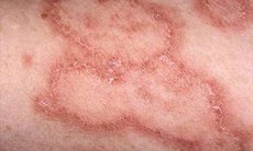 Những triệu chứng giúp chẩn đoán bệnh lupus