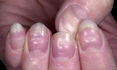 Nhìn móng tay đoán bệnh