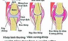 Bạn biết gì về bệnh Still?