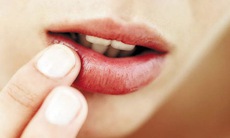 Viêm môi bong vảy - Trị có khó không?