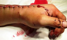 Nối thành công 1 ca đứt lìa bàn tay 