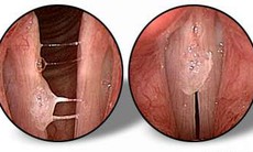 Khàn tiếng do nấm thanh quản