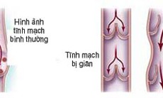 Điêu trị bệnh giãn tĩnh mạch chi dưới