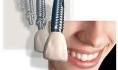 Ðối tượng nào không nên cấy implant?