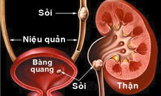 Thuốc dùng trong điều trị sỏi tiết niệu