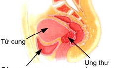 10 nguyên nhân gây cường kinh