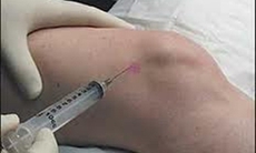 Tiêm vào khớp thoái hóa - Nên hay không?