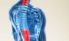 Gai đôi cột sống và chế độ tập luyện, ăn uống