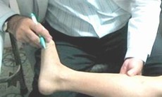 Viêm tắc động mạch chi dưới, đừng để quá muộn!