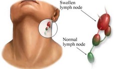 Bệnh u lympho ác tính không Hodgkin có dễ phát hiện?