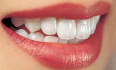 Tôi làm biến màu răng