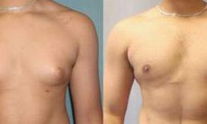 Phì đại tuyến vú ở nam giới
