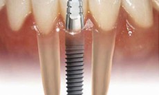 Cấy ghép implant nha khoa