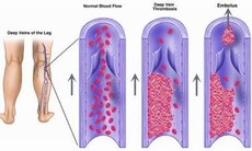 Bạn có biết bệnh Buerger gây tàn phế?
